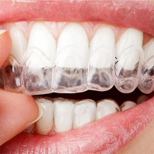 example of a person wearing clear retainers. treatment is available at vyom - the best dental clinic in ahmedabad.