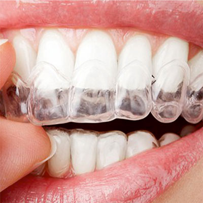 clear-retainers-treatment-ahmedabad